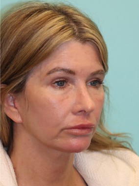 After 6 weeks treatment